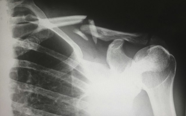 X-ray of injury